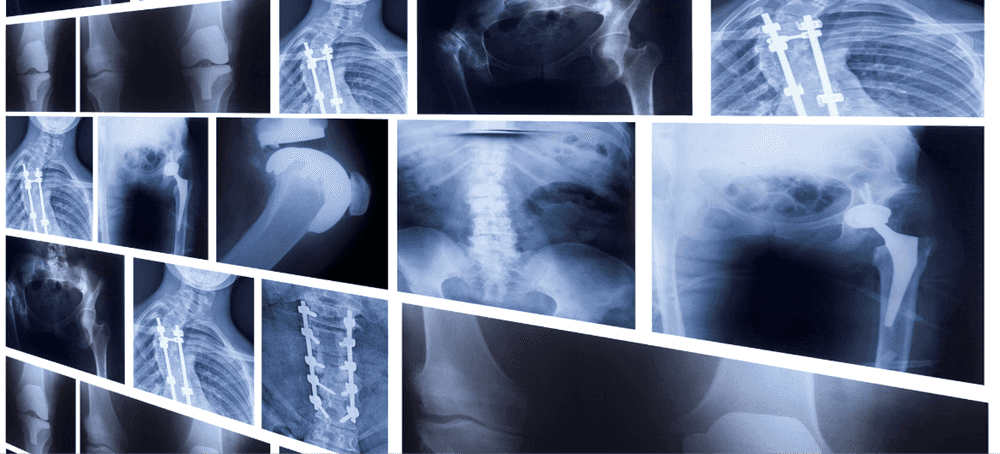 a collage of x-rays of medical implants